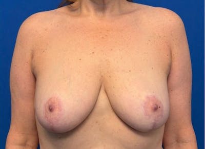 Breast Lift Before & After Gallery - Patient 607020 - Image 6
