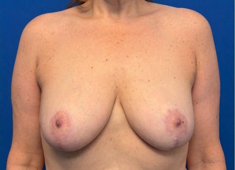 Breast Lift Before & After Gallery - Patient 607020 - Image 6