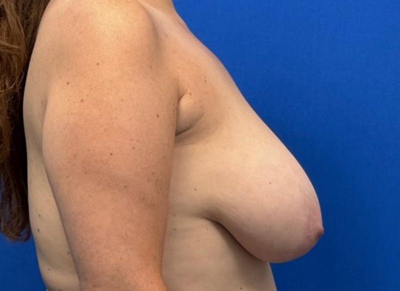 Breast Lift Before & After Gallery - Patient 607020 - Image 9