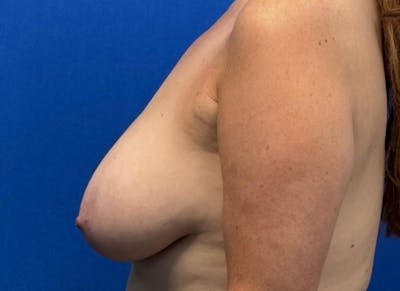 Breast Lift Before & After Gallery - Patient 607020 - Image 1