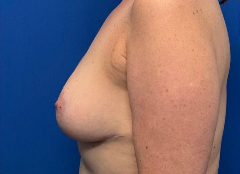 Breast Lift Before & After Gallery - Patient 607020 - Image 2