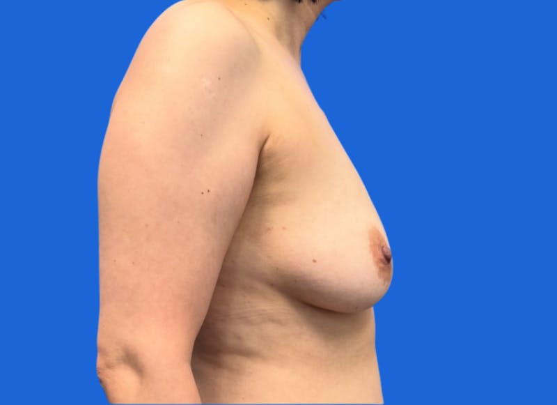 Implant Reconstruction Gallery Before & After Gallery - Patient 514710 - Image 9