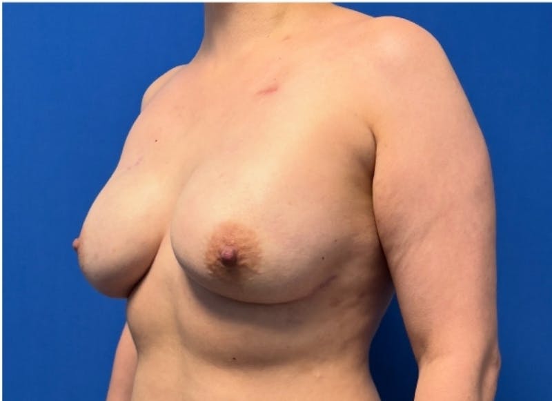 Implant Reconstruction Gallery Before & After Gallery - Patient 514710 - Image 4