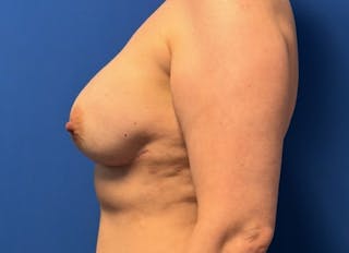 Implant Reconstruction Gallery Before & After Gallery - Patient 514710 - Image 2