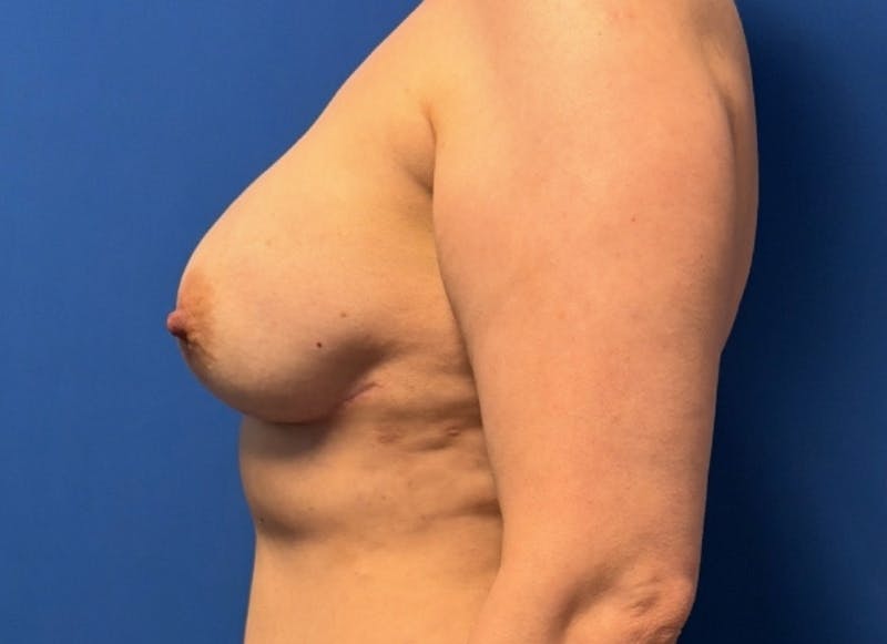 Implant Reconstruction Gallery Before & After Gallery - Patient 514710 - Image 2