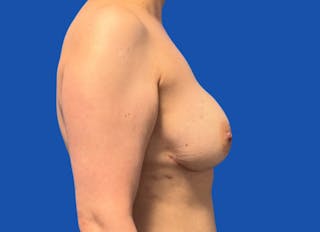 Implant Reconstruction Gallery Before & After Gallery - Patient 514710 - Image 10