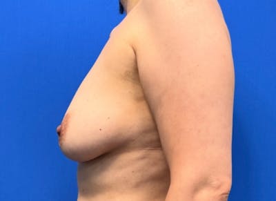 Implant Reconstruction Gallery Before & After Gallery - Patient 514710 - Image 1