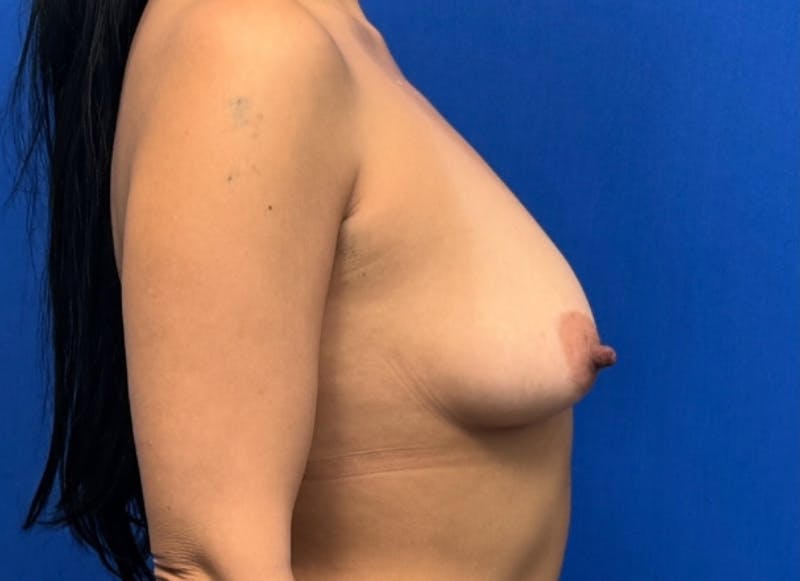 Flap Reconstruction Gallery Before & After Gallery - Patient 163508 - Image 9