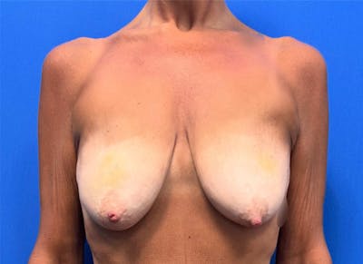Hybrid Reconstruction Gallery Before & After Gallery - Patient 217861 - Image 1