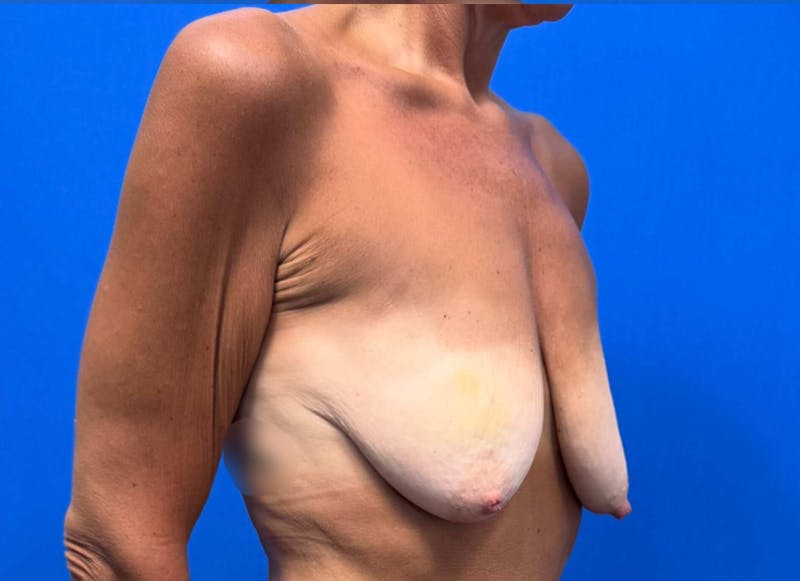Hybrid Reconstruction Gallery Before & After Gallery - Patient 217861 - Image 3