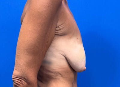 Hybrid Reconstruction Gallery Before & After Gallery - Patient 217861 - Image 5