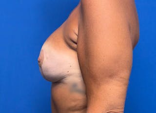 Hybrid Reconstruction Gallery Before & After Gallery - Patient 217861 - Image 10
