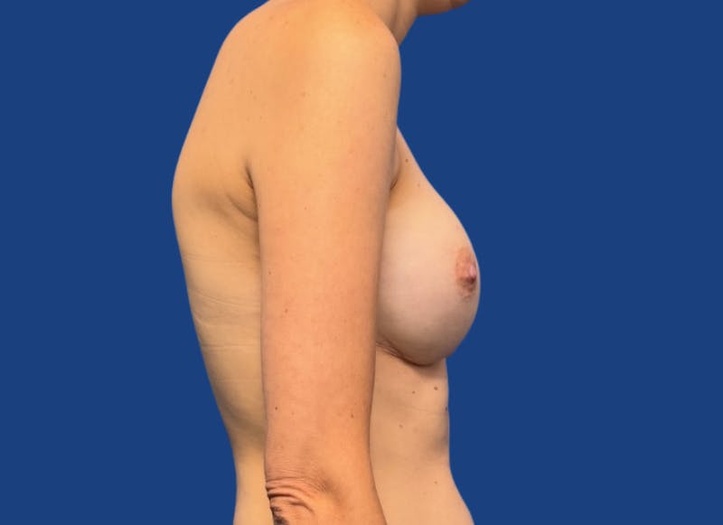 Implant Reconstruction Gallery Before & After Gallery - Patient 424785 - Image 10