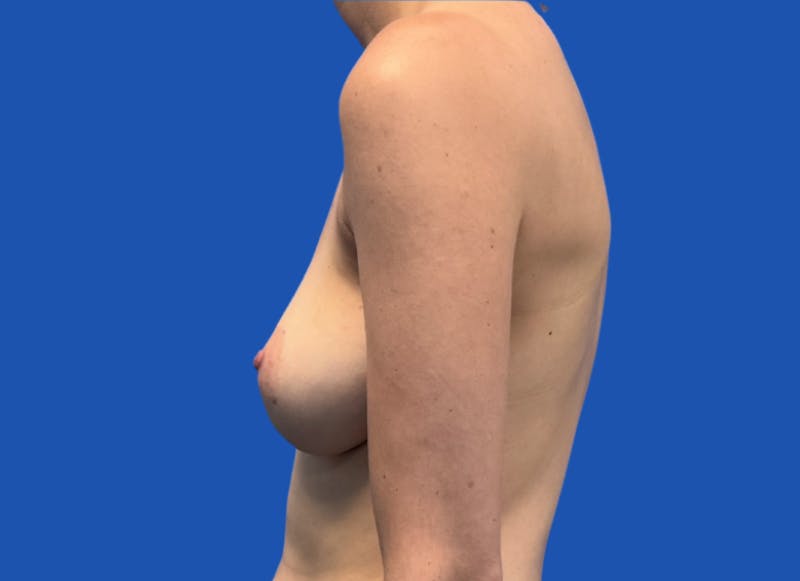 Implant Reconstruction Gallery Before & After Gallery - Patient 424785 - Image 1