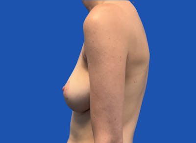 Implant Reconstruction Gallery Before & After Gallery - Patient 424785 - Image 1