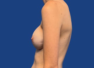 Implant Reconstruction Gallery Before & After Gallery - Patient 424785 - Image 2