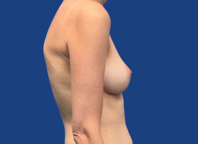 Implant Reconstruction Gallery Before & After Gallery - Patient 424785 - Image 9