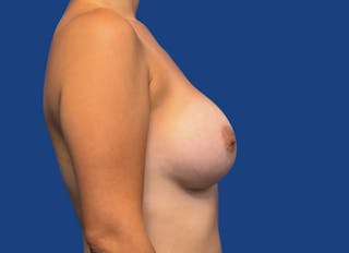 Augmentation Before & After Gallery - Patient 380880 - Image 10