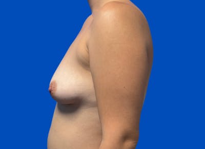 Augmentation Before & After Gallery - Patient 380880 - Image 1