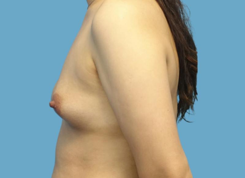 Implant Reconstruction Gallery Before & After Gallery - Patient 200156 - Image 1