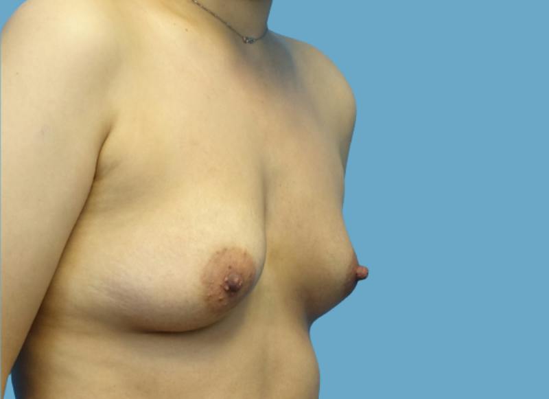 Implant Reconstruction Gallery Before & After Gallery - Patient 200156 - Image 7