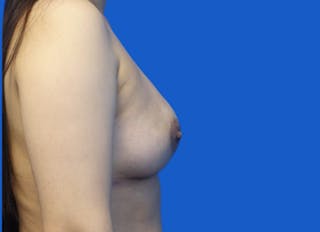 Implant Reconstruction Gallery Before & After Gallery - Patient 200156 - Image 10
