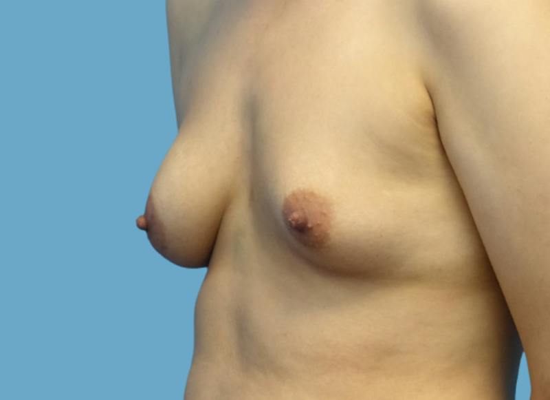 Implant Reconstruction Gallery Before & After Gallery - Patient 200156 - Image 3
