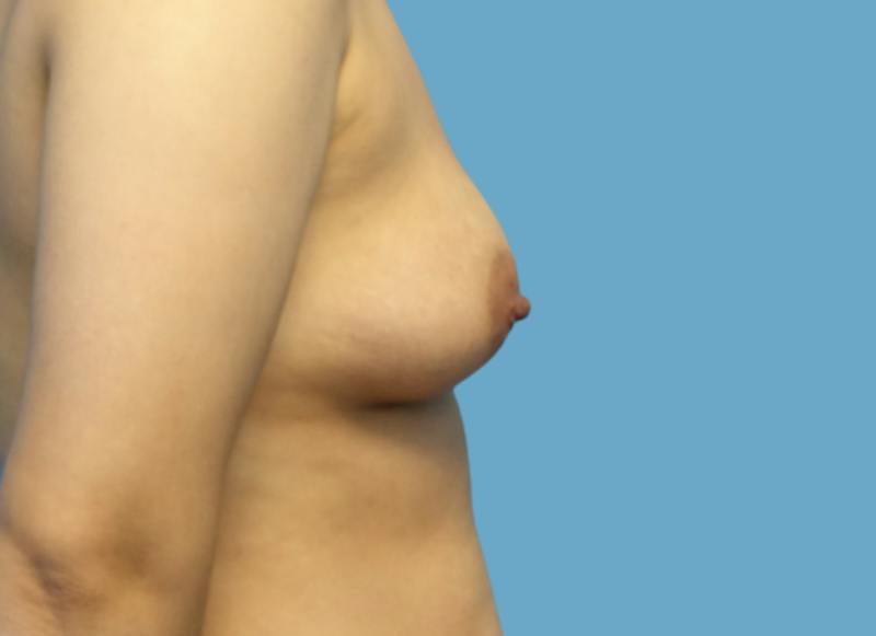 Implant Reconstruction Gallery Before & After Gallery - Patient 200156 - Image 9