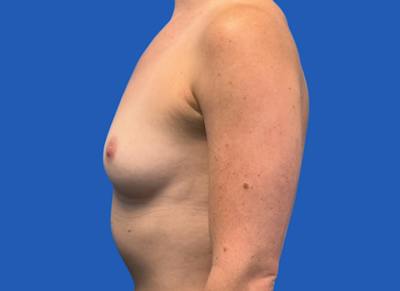 Implant Reconstruction Gallery Before & After Gallery - Patient 315093 - Image 1