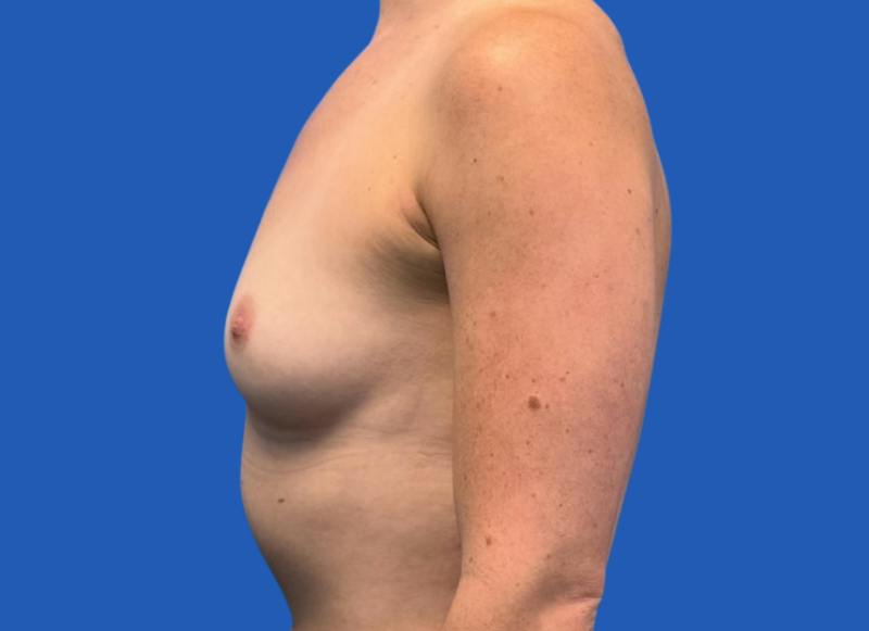 Implant Reconstruction Gallery Before & After Gallery - Patient 315093 - Image 1