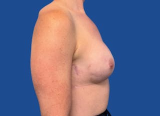 Implant Reconstruction Gallery Before & After Gallery - Patient 315093 - Image 10