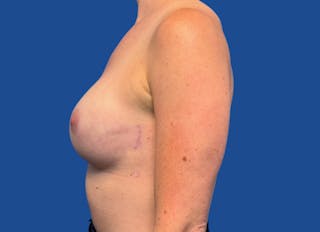 Implant Reconstruction Gallery Before & After Gallery - Patient 315093 - Image 2