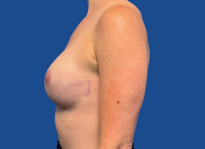 Implant Reconstruction Gallery Before & After Gallery - Patient 315093 - Image 2