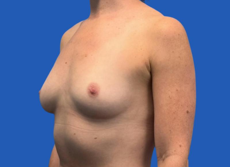 Implant Reconstruction Gallery Before & After Gallery - Patient 315093 - Image 3
