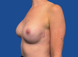 Implant Reconstruction Gallery Before & After Gallery - Patient 315093 - Image 4