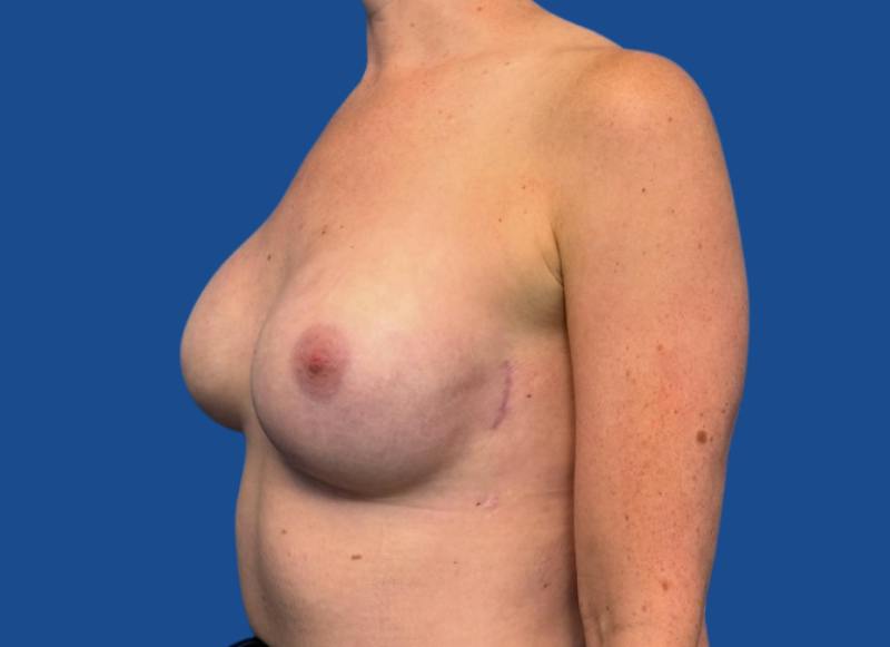 Implant Reconstruction Gallery Before & After Gallery - Patient 315093 - Image 4
