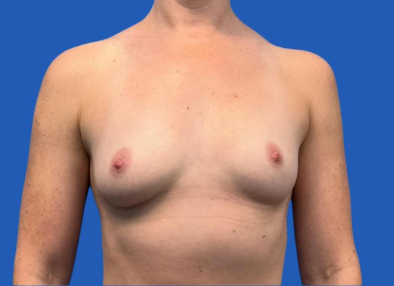 Implant Reconstruction Gallery Before & After Gallery - Patient 315093 - Image 5