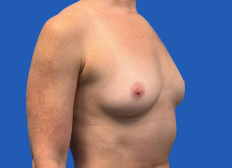 Implant Reconstruction Gallery Before & After Gallery - Patient 315093 - Image 7