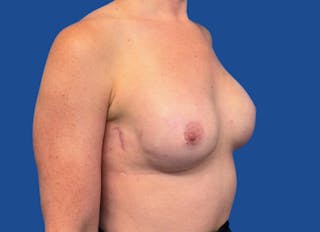 Implant Reconstruction Gallery Before & After Gallery - Patient 315093 - Image 8