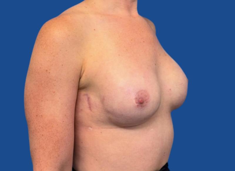 Implant Reconstruction Gallery Before & After Gallery - Patient 315093 - Image 8