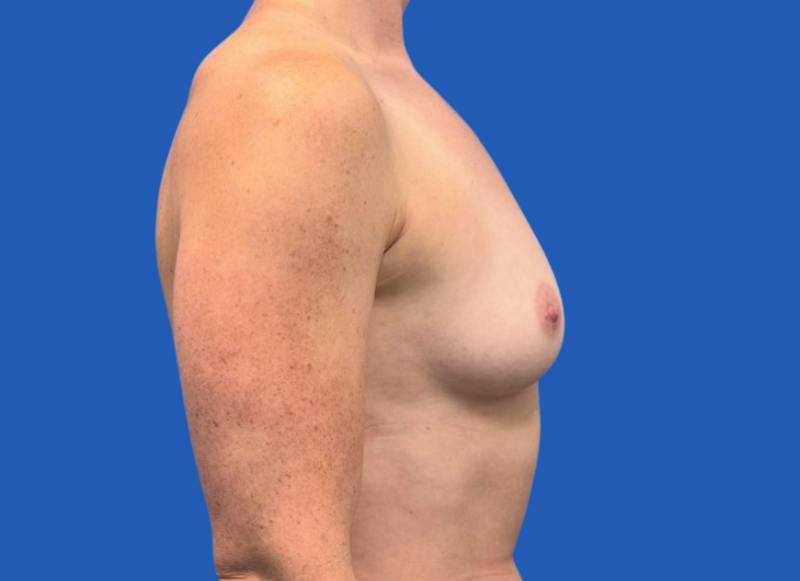 Implant Reconstruction Gallery Before & After Gallery - Patient 315093 - Image 9