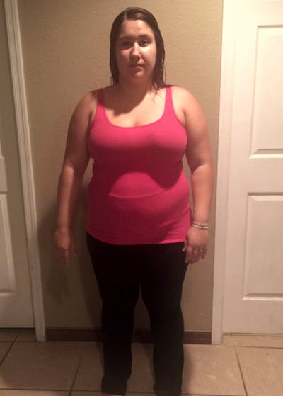 Weight Loss Before & After Gallery - Patient 119275928 - Image 1