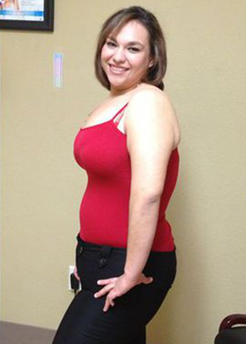 Weight Loss Before & After Gallery - Patient 119275946 - Image 2