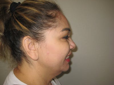 BOTOX Before & After Gallery - Patient 127577234 - Image 2