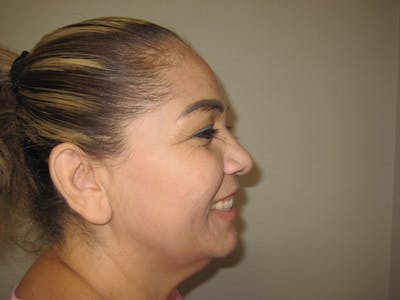 BOTOX Before & After Gallery - Patient 127577234 - Image 1