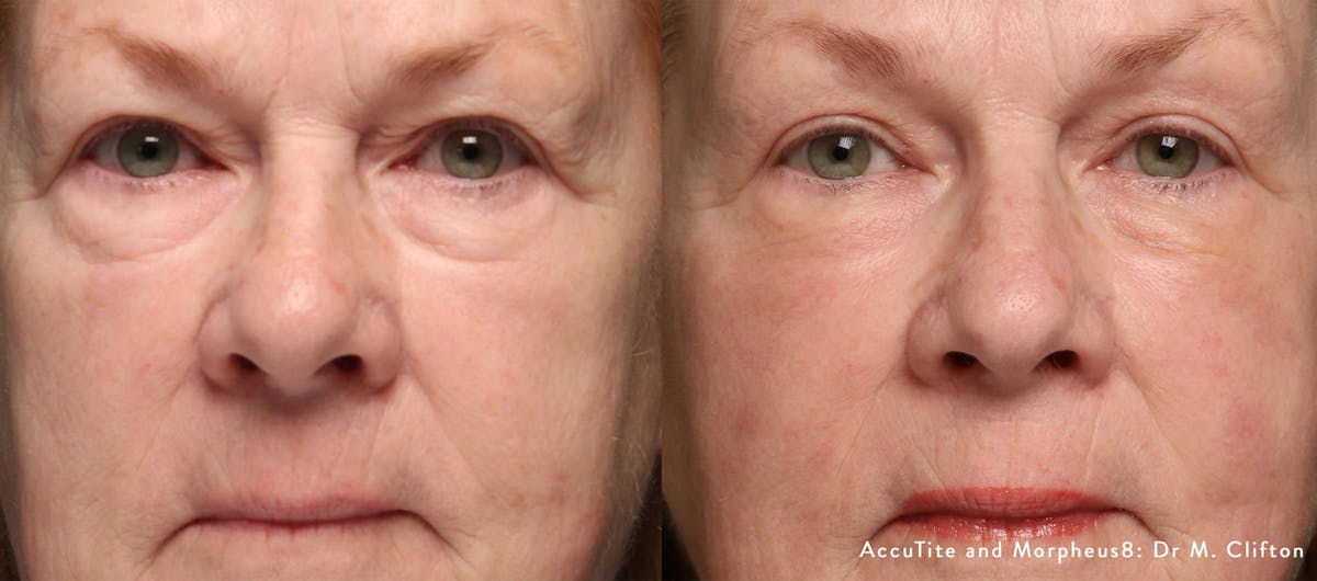 Morpheus 8 Before & After Gallery - Patient 128405900 - Image 1