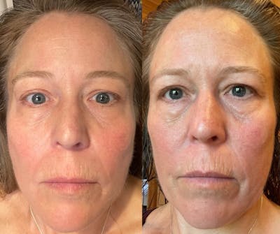 Morpheus 8 Before & After Gallery - Patient 117821088 - Image 1