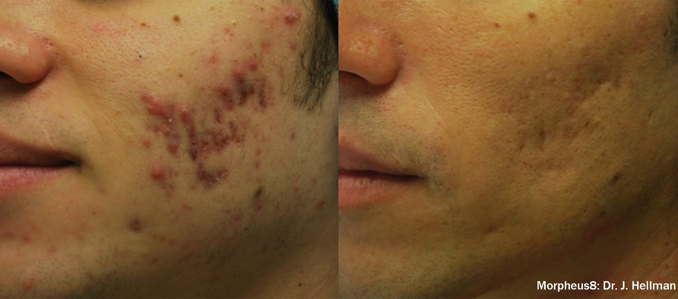 Morpheus 8 Before & After Gallery - Patient 128405920 - Image 2