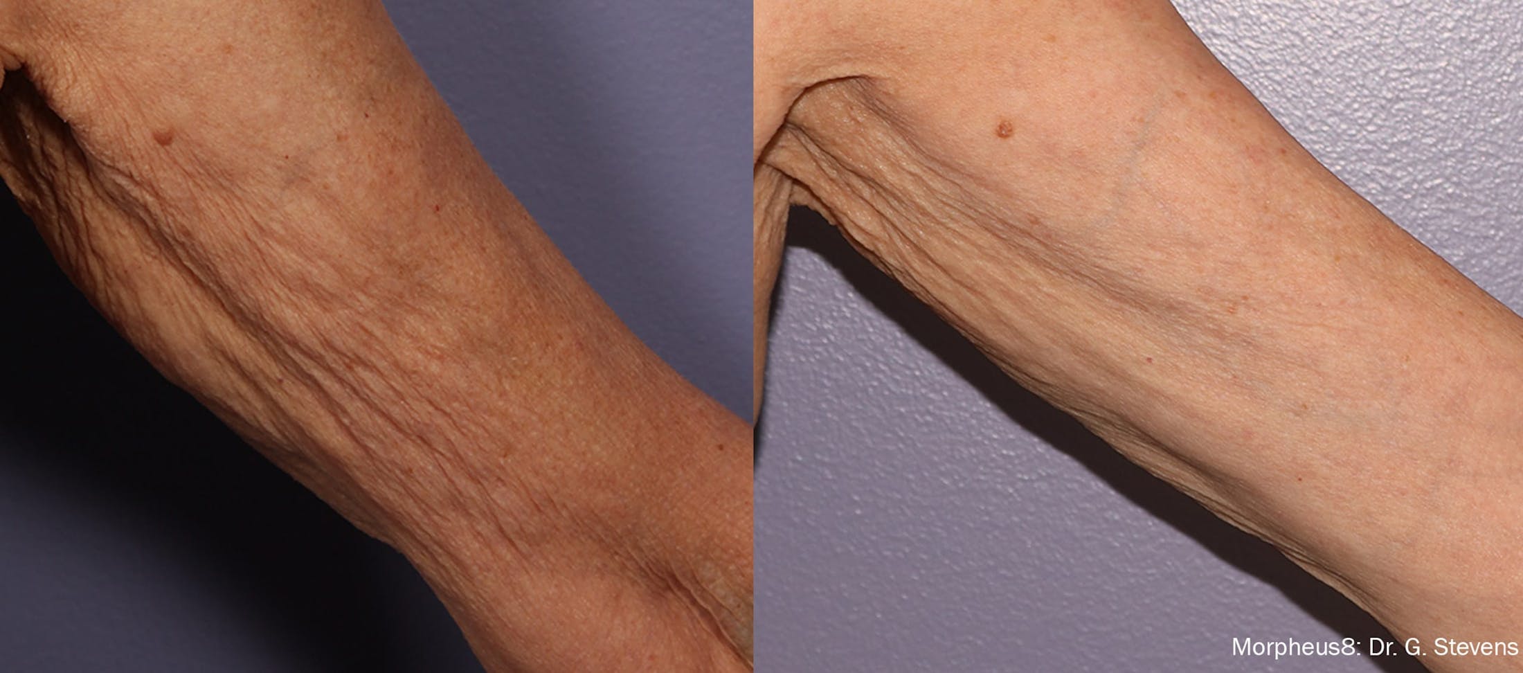 Morpheus 8 Before & After Gallery - Patient 128405923 - Image 1