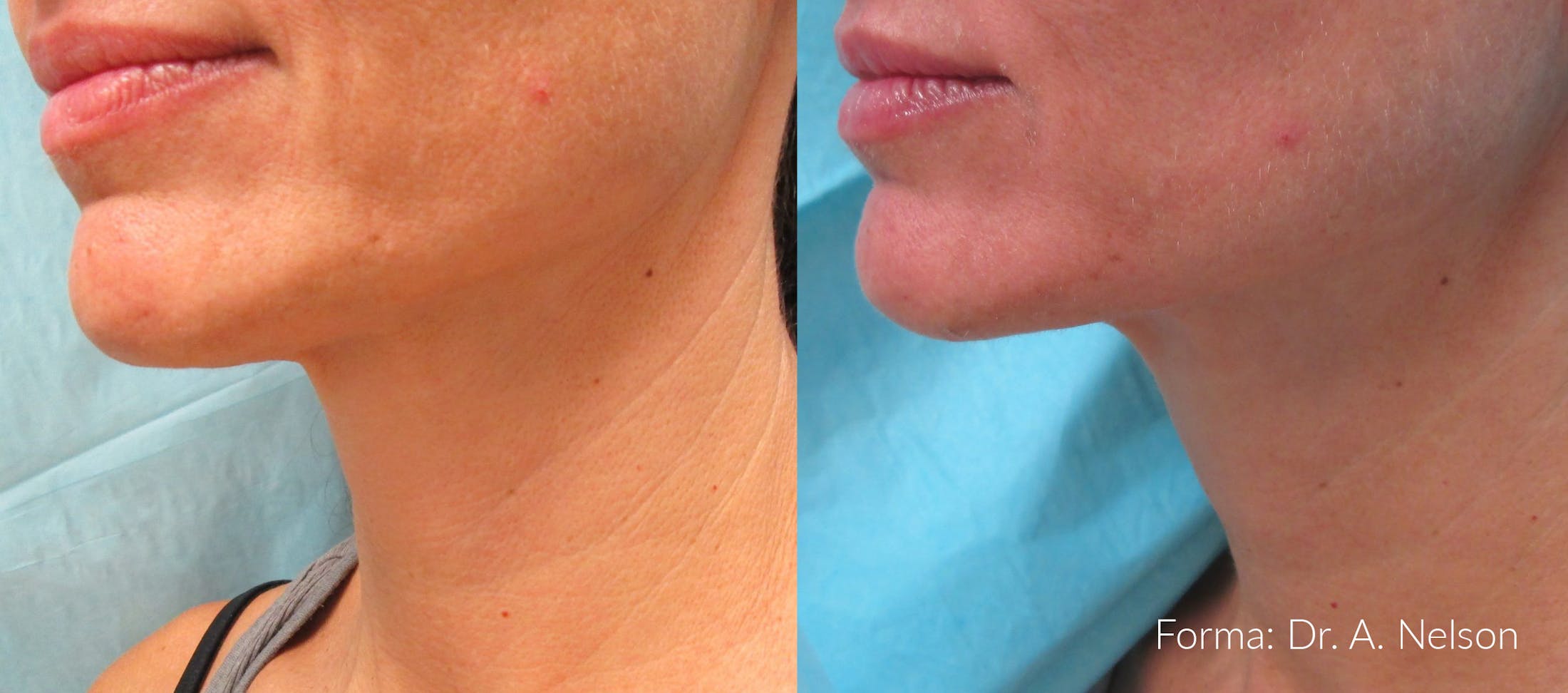 Forma Skin Tightening Before & After Gallery - Patient 128405938 - Image 1